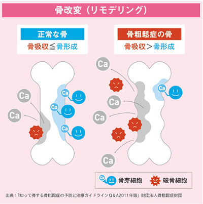 骨改変（リモデリング）